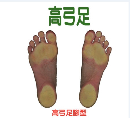 常見足弓及腳掌變症(二) 高弓足
