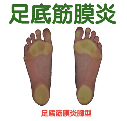 中醫綜合療法 治療『 足底筋膜炎 』效果佳
