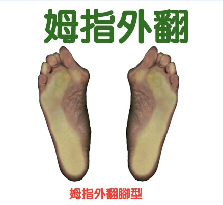 常見足弓及腳掌變症(四) 拇趾外翻