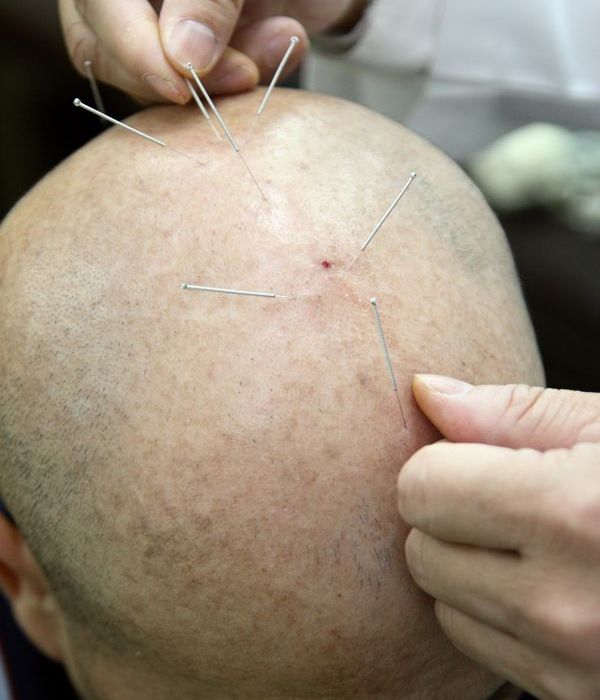 中醫『針灸』對於 中風後遺症 的康復，有絶佳的治療效果！！